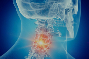 arthrose cervicale