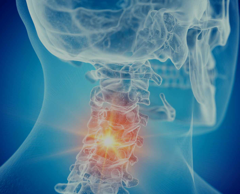 arthrose cervicale
