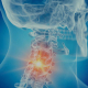 arthrose cervicale